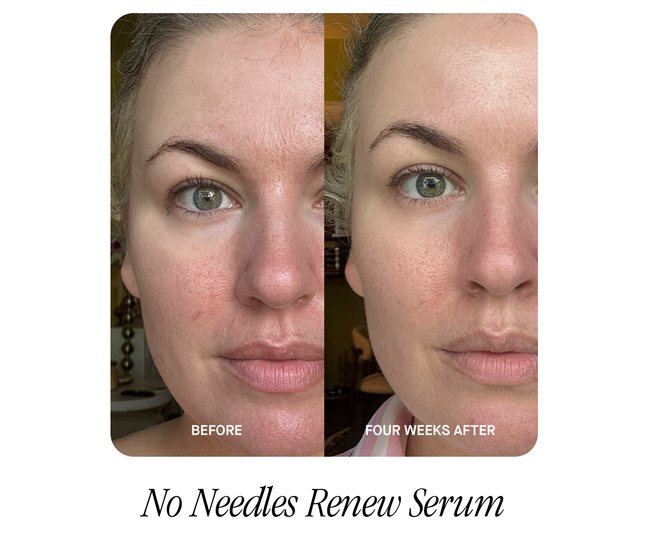 No Needles Renew Serum
