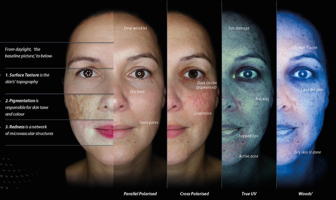 Comparison of facial skin under four imaging techniques: parallel polarized, cross polarized, true UV, and Wood’s light, highlighting wrinkles, pigmentation, redness, sun damage, and oil distribution. Fearrington Village.