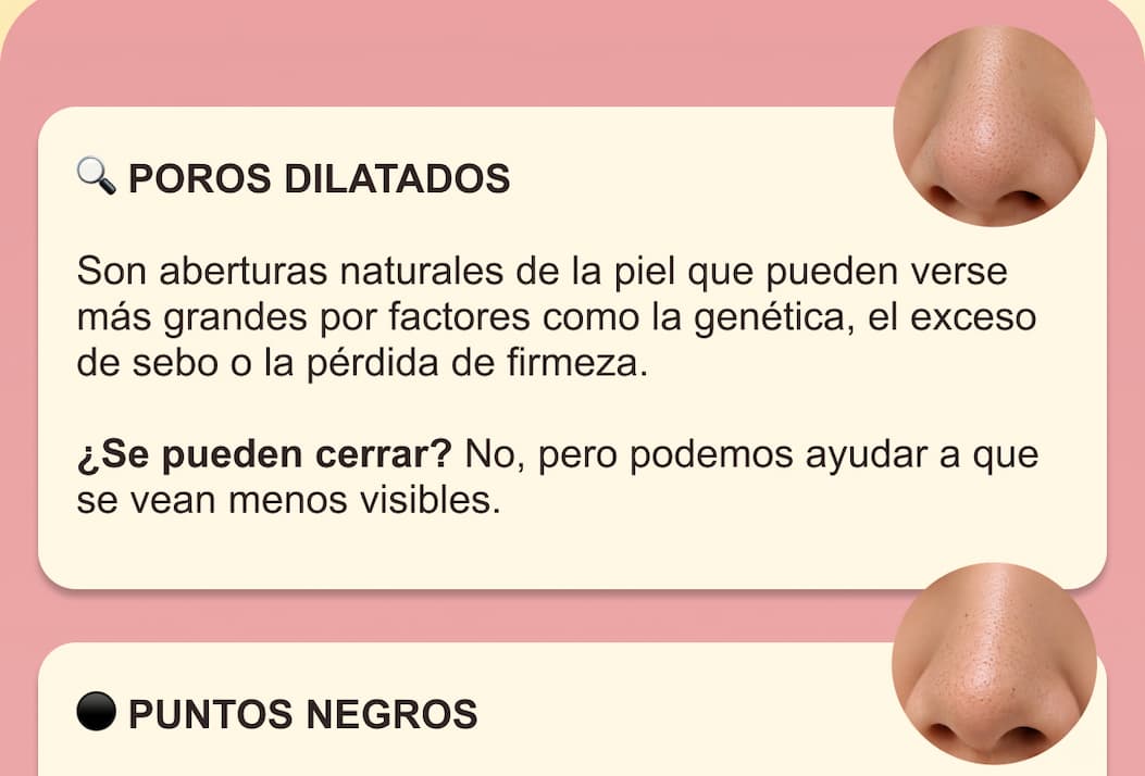 ¿Poros dilatados o puntos negros? — 3