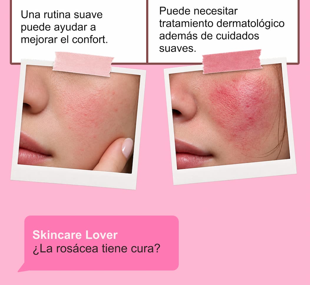 ¿Rosácea o piel sensible? — 4