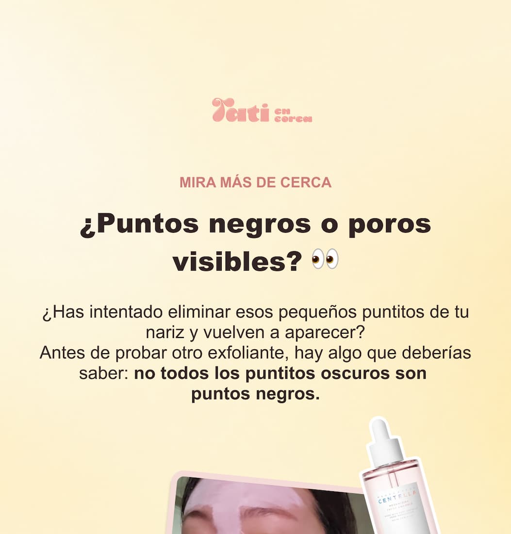 ¿Poros dilatados o puntos negros? — 1