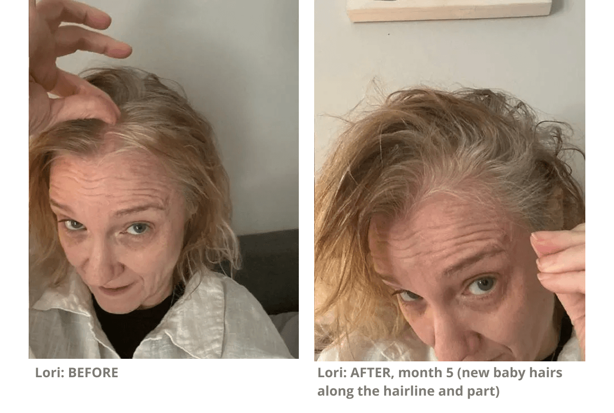 Lori: AFTER, month 5 (new baby hairs along the hairline and part)