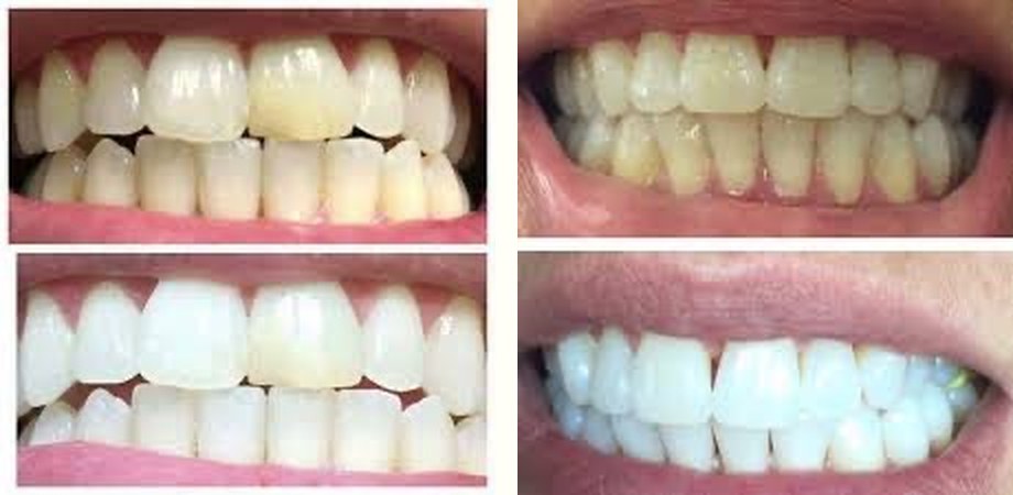 AP 24 toothpaste before and after